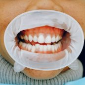 Czy wybielanie zębów w domu jest bezpieczne?